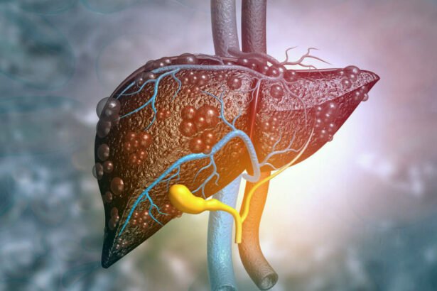 цироз печінки