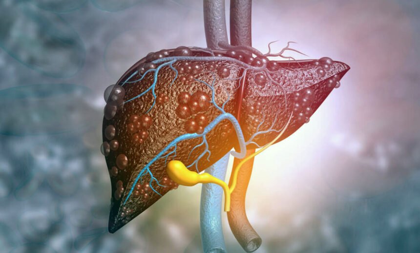 цироз печінки